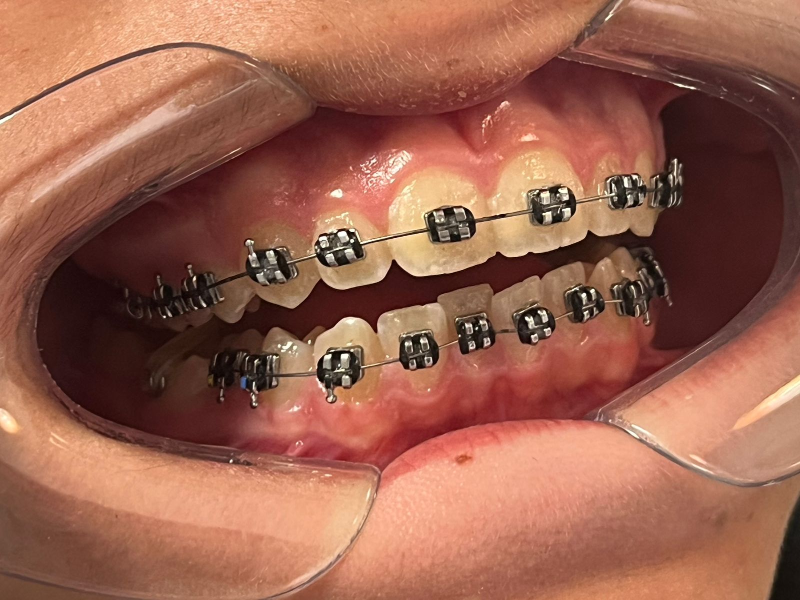 Jovem sorrindo com aparelho ortodôntico