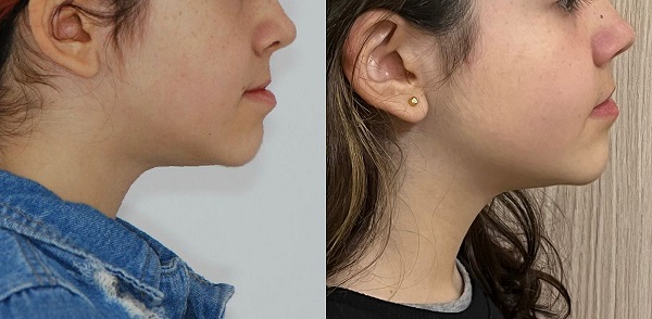 Antes e depois da Ortopedia Funcional dos Maxilares