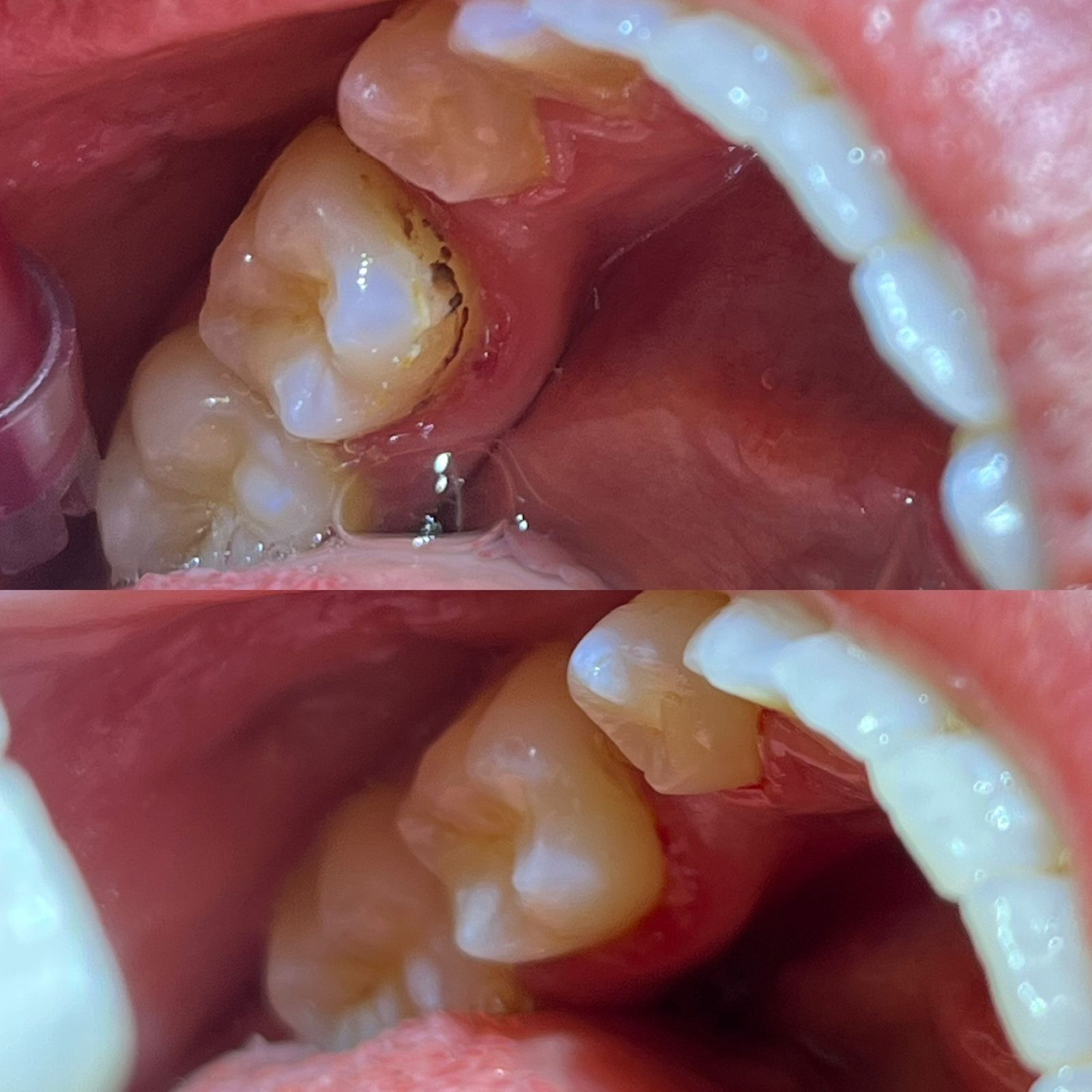 Limpeza dental profissional